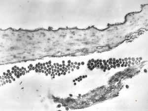 F, 39y. | collagenous and elastin fibers from corium F, 39y. | collagenous and elastin fibers from corium